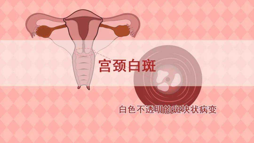 宫颈白斑是指女性的子宫经阴道出现了白色的斑块状病变