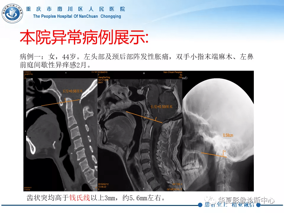 颅底凹陷症合并脊髓空洞病例分析