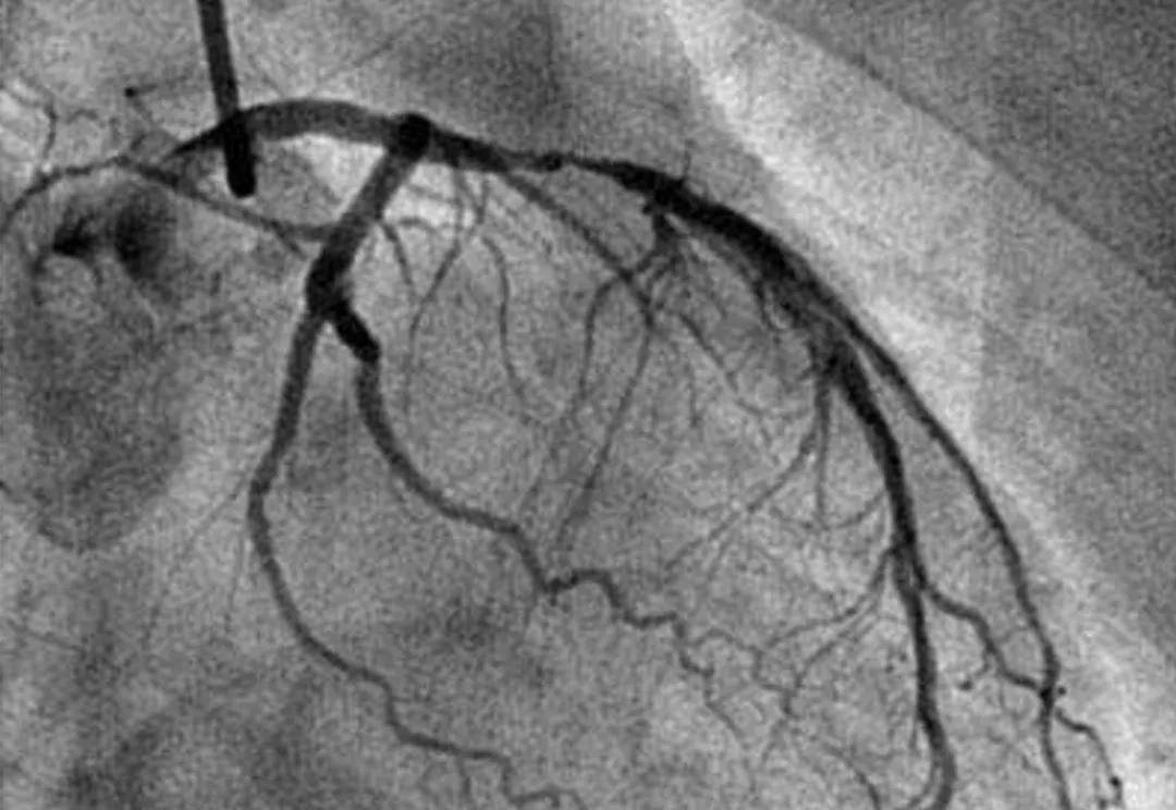 同时,冠状动脉造影也有一定的局限性,例如对心脏结构,功能和心肌血液