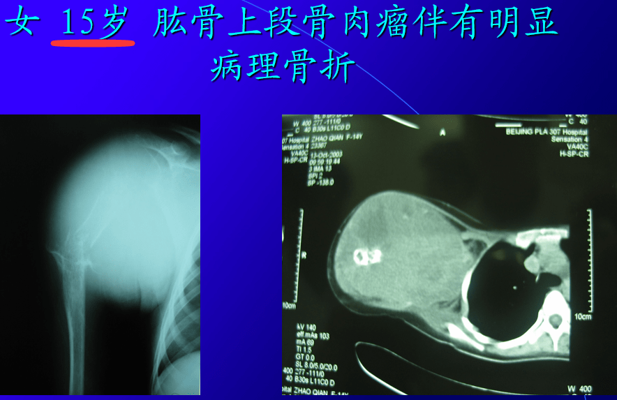 骨癌毁了很多孩子和家庭,家长要反思!医生提醒:这种腿