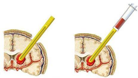 什么原因会引起脑部出血 1a1aa0fc055344e0b77831bc1a8a3d68.jpeg