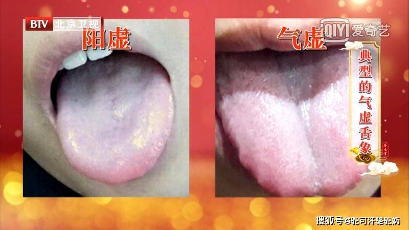 舌象是在不断变化的,一般来说,舌苔 从薄变厚可能提示病情加重,而由厚