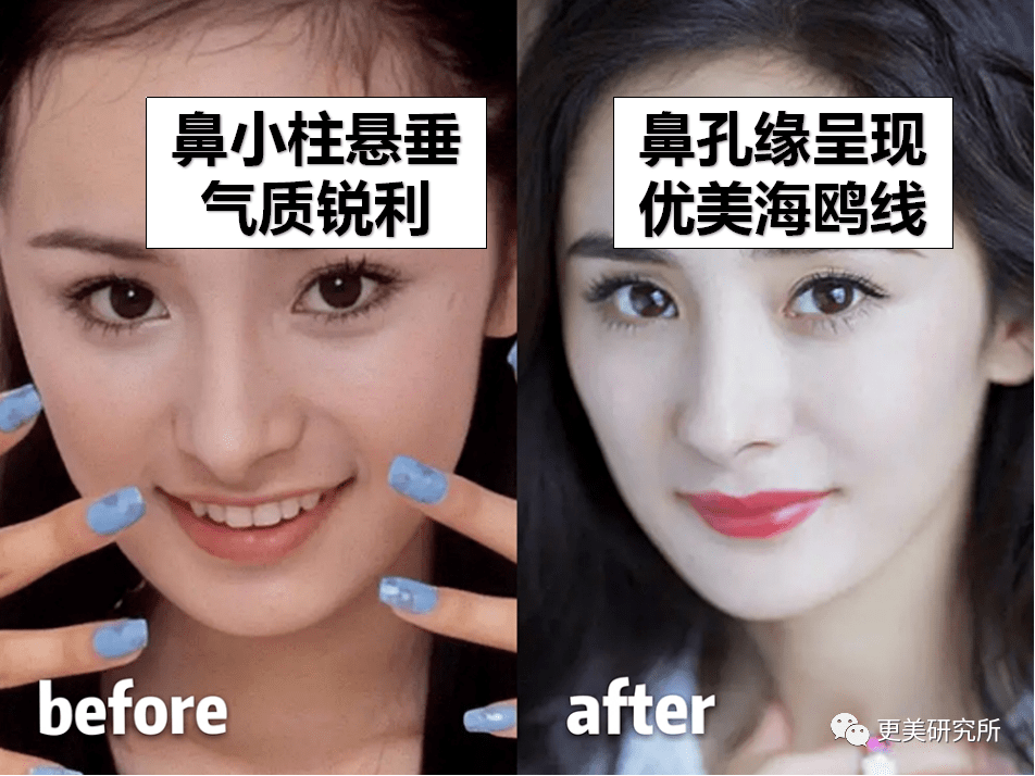 鼻尖|杨幂终于去修复鼻子了…