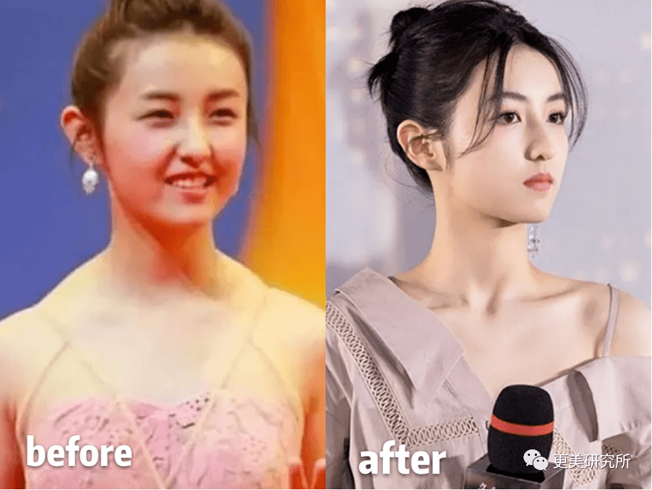 脂肪|鞠婧祎再花70w能do成迪丽热巴的前凸后翘？！