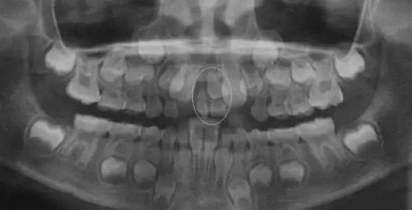 在医学上,这被称作多齿症.先口牙?""哇,应该没有吧,想想都恐怖!"前