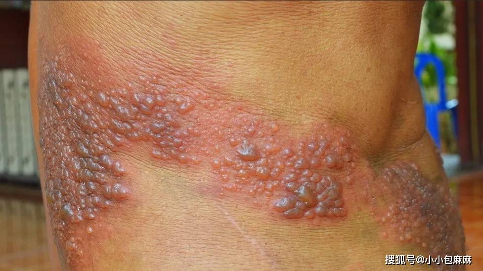 老人|在悄悄折磨我们老去的父母...比生孩子还疼！这个病