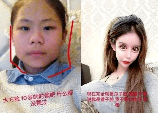 细节|13岁开始整容的周楚娜公开相关细节：花费四百万，打上百针麻药
