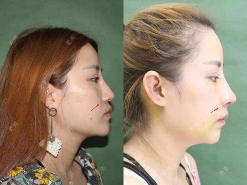 fa|央视镜头太可怕了,张天爱鼻子顶破天,被李沁吊打…