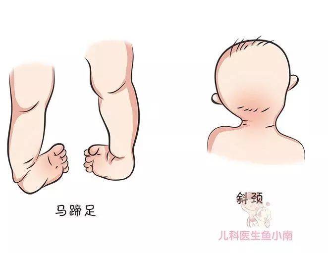 宝宝腿纹臀纹不对称就是髋关节发育不良吗为啥说越早发现越好