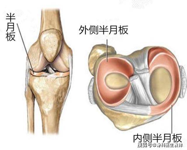 半月板损伤应该怎么