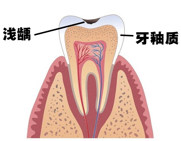 讲完牙齿外面最常见疾病--牙周炎,再讲讲牙齿里面最常见疾病--龋齿