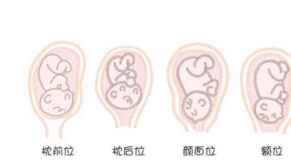 怎么才算胎位不正 f91f0d64429c438ca91d10bba899ba40.jpeg