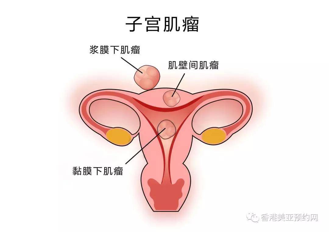 子宫肌瘤是育龄妇女的高发病!做到这3点可以预防!