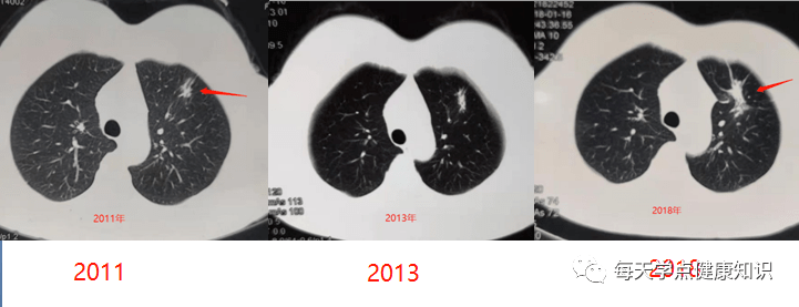 肺部硬结灶怎么办