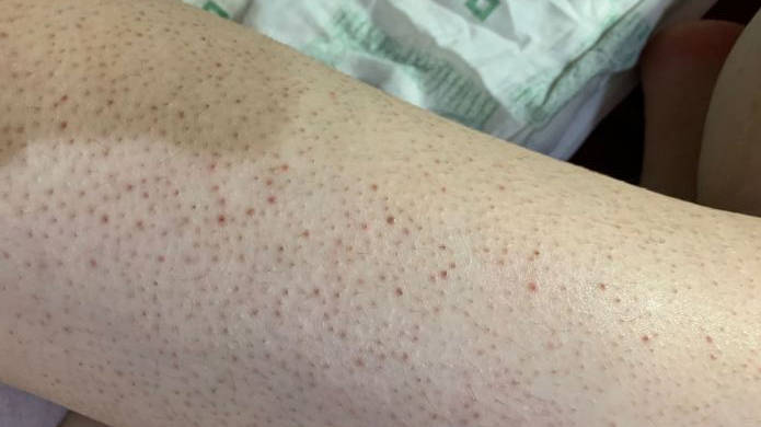 鸡皮肤怎么去除最有效 去鸡皮肤正确方法