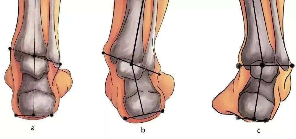 为 踝关节内侧肿胀,疼痛,行走疲乏; 后期可逐渐加重至足弓逐渐塌陷