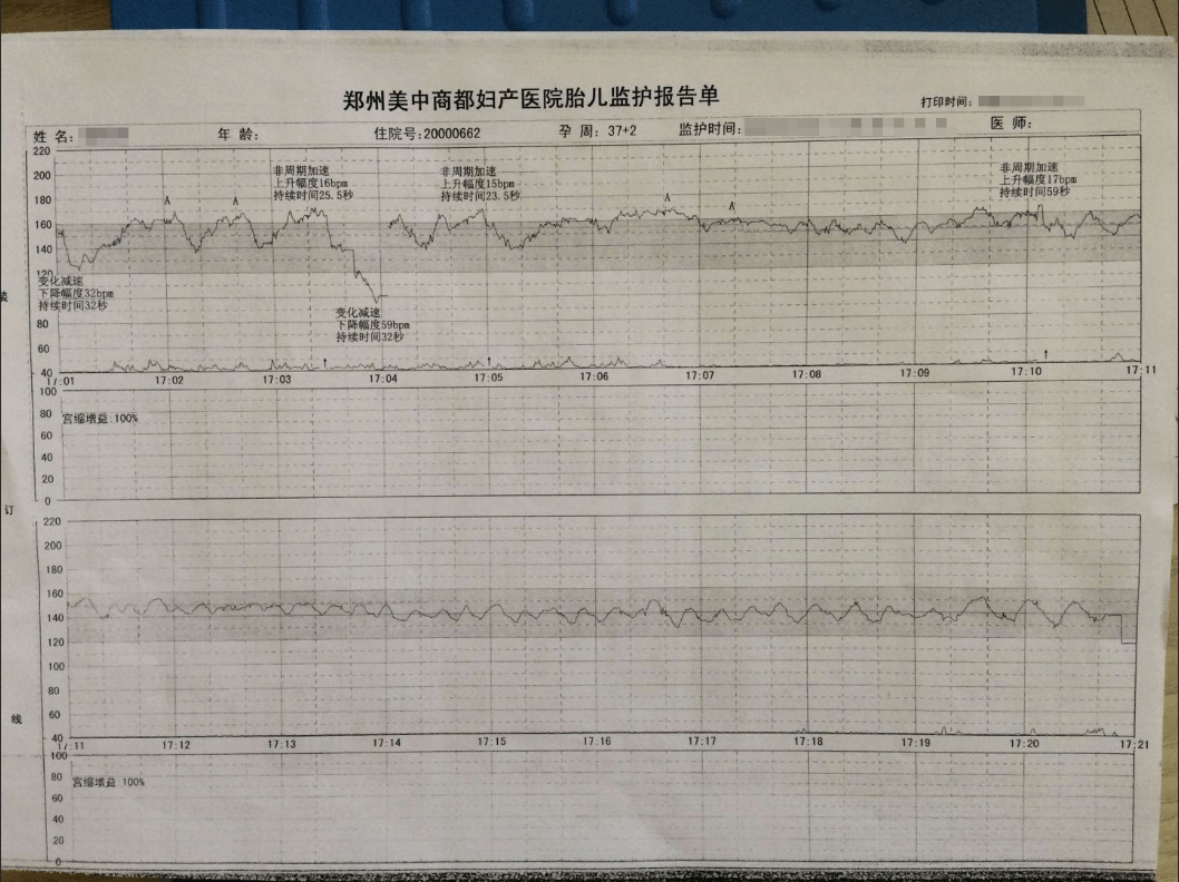 胎心不稳定,突然看到她的胎心监护出现罕见的正弦波