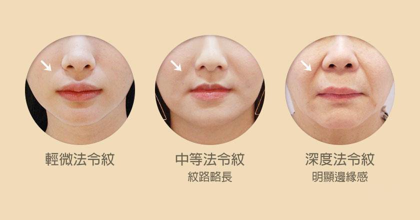 巅峰|法令纹还有救吗？想要重返颜值巅峰，还真的靠这点