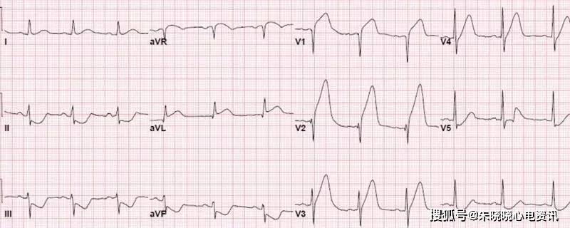 急性心梗的5类心电图表现,牢记于心!