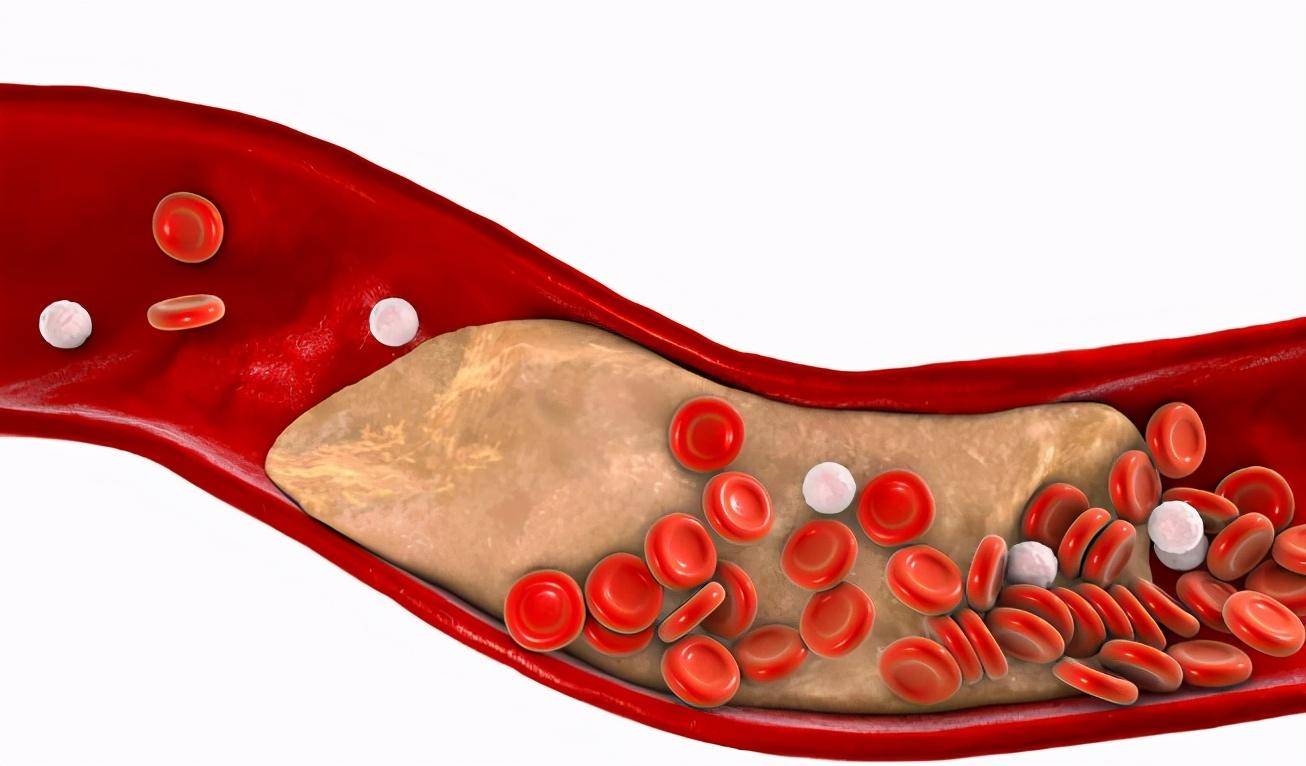身体出现5大异常十有八九血脂高了改善血脂坚持六个一