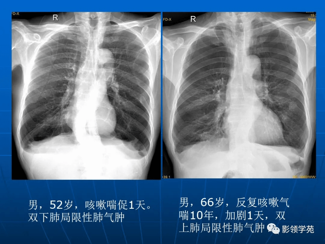 肺气肿的影像诊断