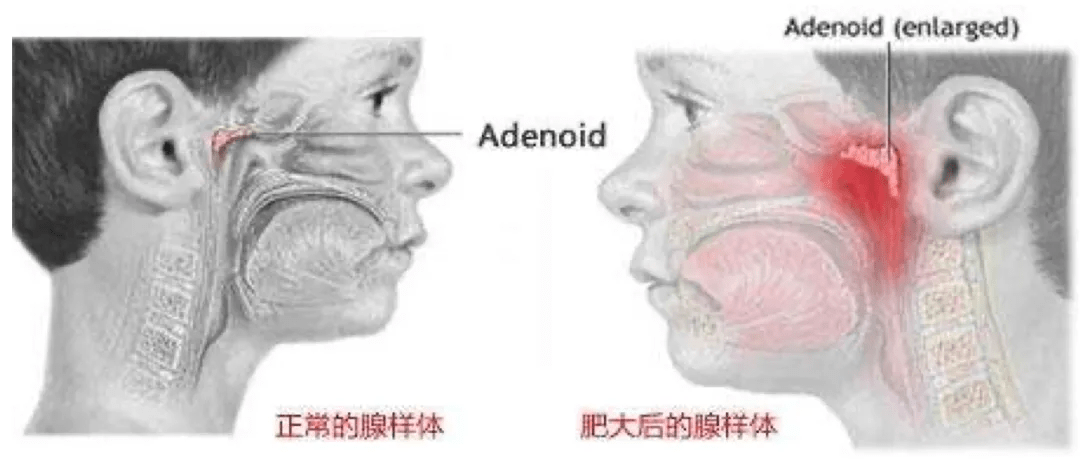 儿童腺样体肥大会拉低颜值和智商吗