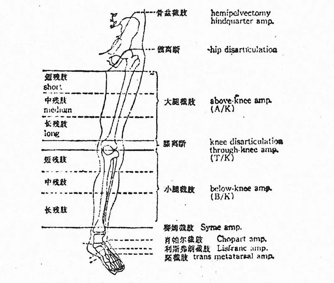 想要假肢效果好,截肢部位很关键!(下肢篇)_小腿