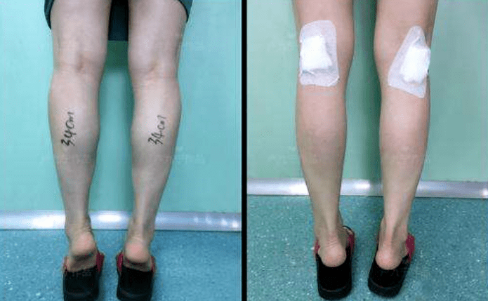 手术|杨幂关晓彤杠上了？撞衫尴尬就算了，还被网友喷做了直腿手术…