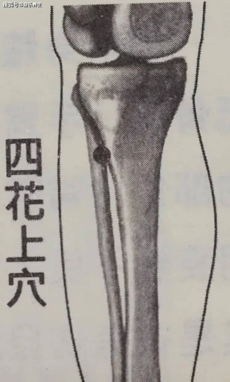 四花上穴位于外膝眼(外犊鼻)直下3寸,胫骨外帘,贴骨下针;直刺1寸5分.