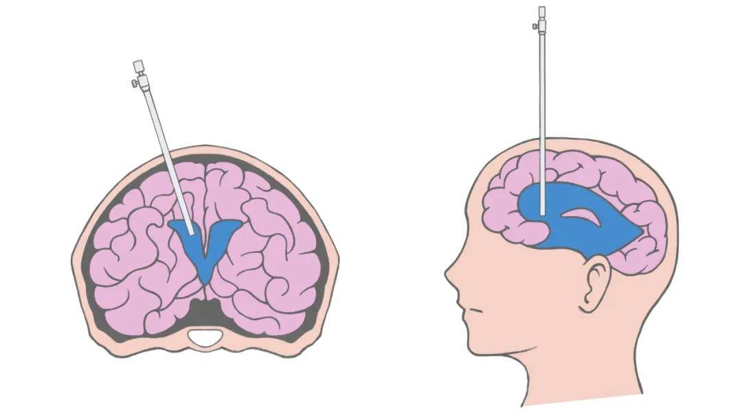 【医者解读】拍ct意外查出脑积水,没有症状还要治疗吗