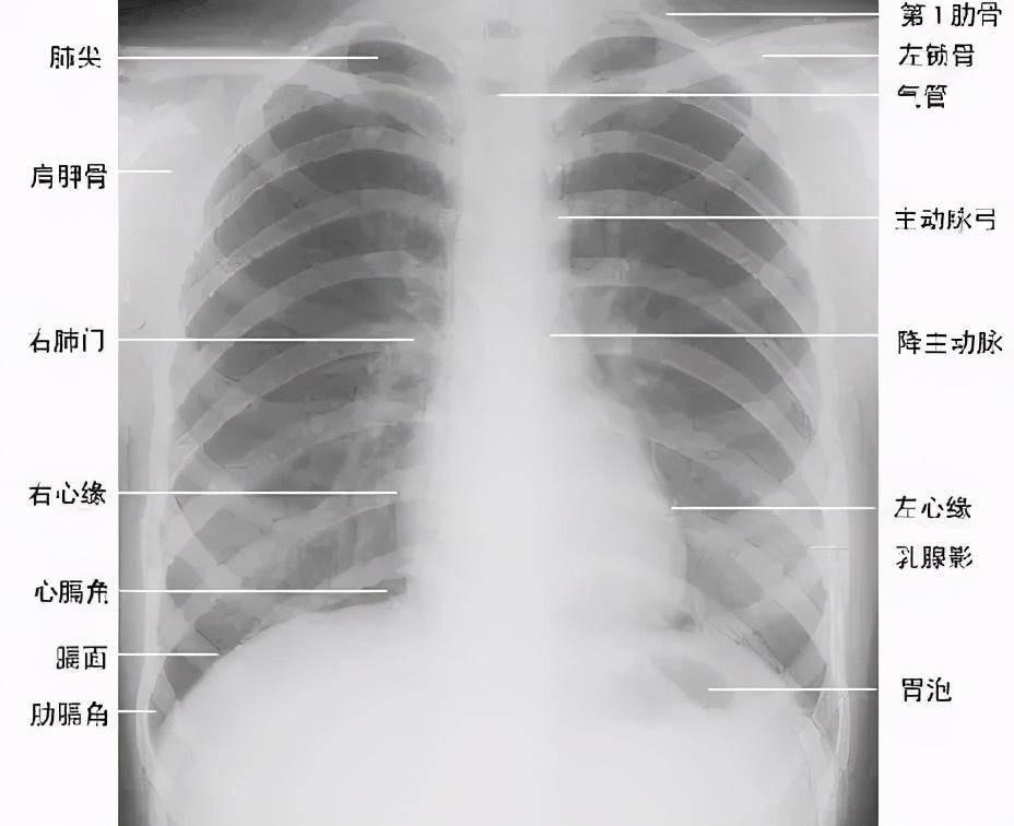 胸片入门攻略,看完不信你还学不会!