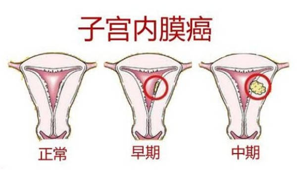 多囊卵巢综合征和子宫内膜癌有哪些关联