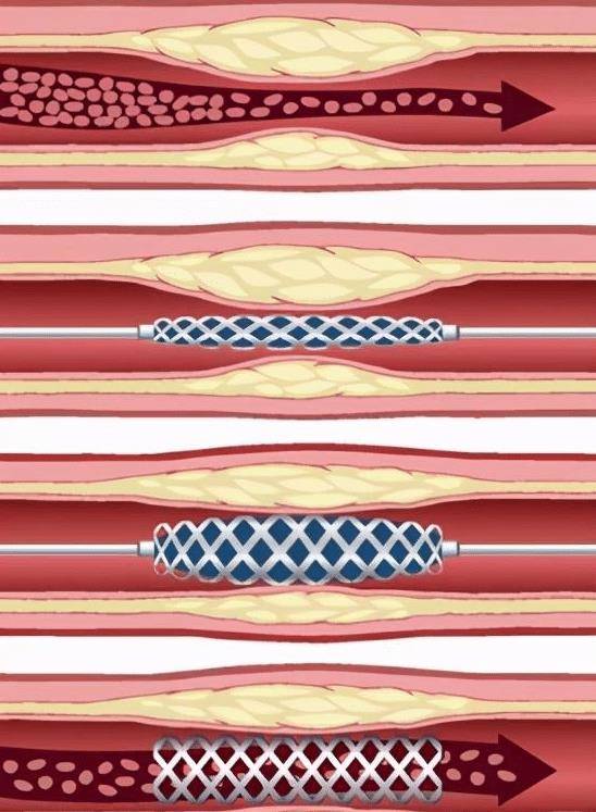 原创心脏支架降价了!这或许是药物价格下跌的开始!