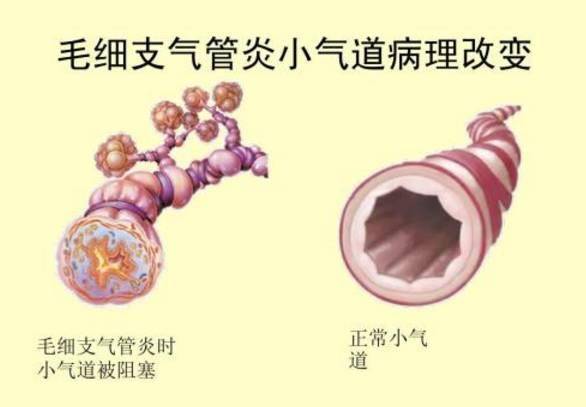 什么叫毛细支气管炎 a797d89f0c1f4d0fb78133efd2cbc6ec.jpeg