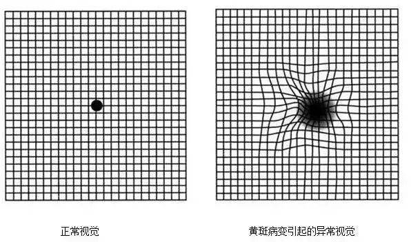 只需一张图,就可以检测眼底黄斑变性?