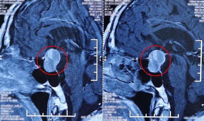 原创垂体瘤患者一定要这三个检查,缺一不可!