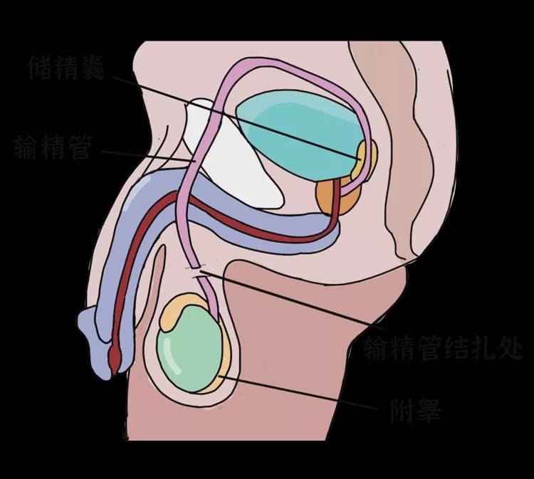 关于夫妻避孕这件事,男的结扎还是女性节育,哪个更好?