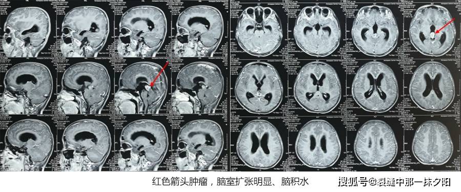 生殖细胞瘤术后脑积水脑疝案例