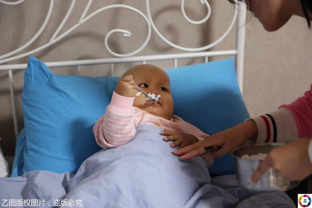 怪物|大如气球,妈妈心痛却束手无策四川2岁小萝莉肚里长“怪物”