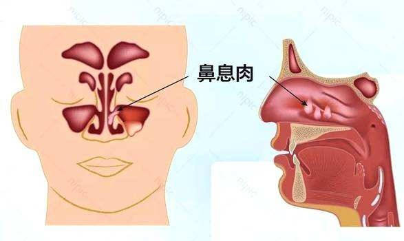 2,咽炎,支气管哮喘:鼻息肉,会造成咽部粘膜受压,引发慢性咽喉炎,还可