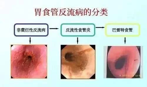 饭后返胃酸怎么办