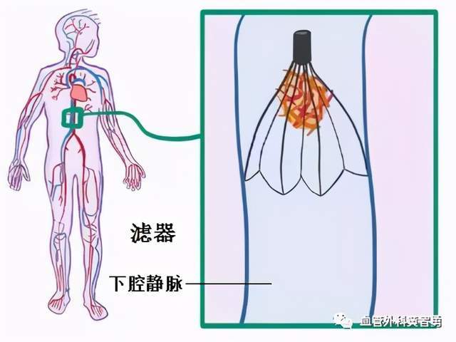 孕妇静脉血栓怎么办