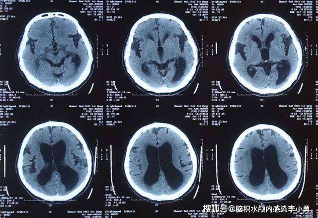 2017年10月19日,在山西省某三甲医院复查头颅ct提示:"脑积水较前增加"