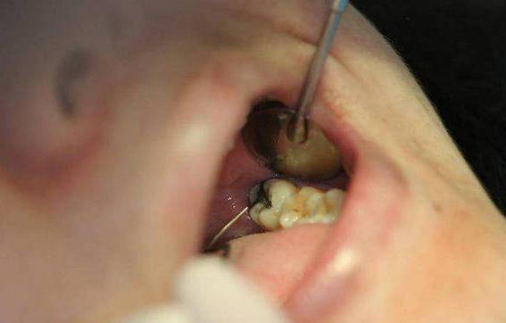 侵犯邻牙空间的智齿通常智齿萌发的空间不足,而会倒在第二大臼齿上