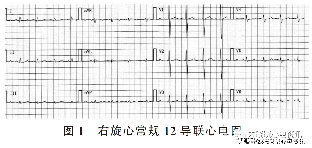 右旋心心电图特征及意义