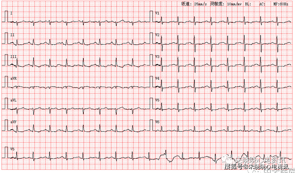 患者女,66岁,因胸闷心悸来医院就诊,图为其体检心电图