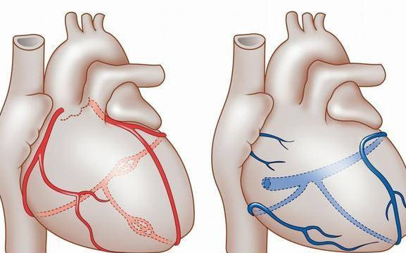原创做了心脏搭桥手术能活多久需要注意什么
