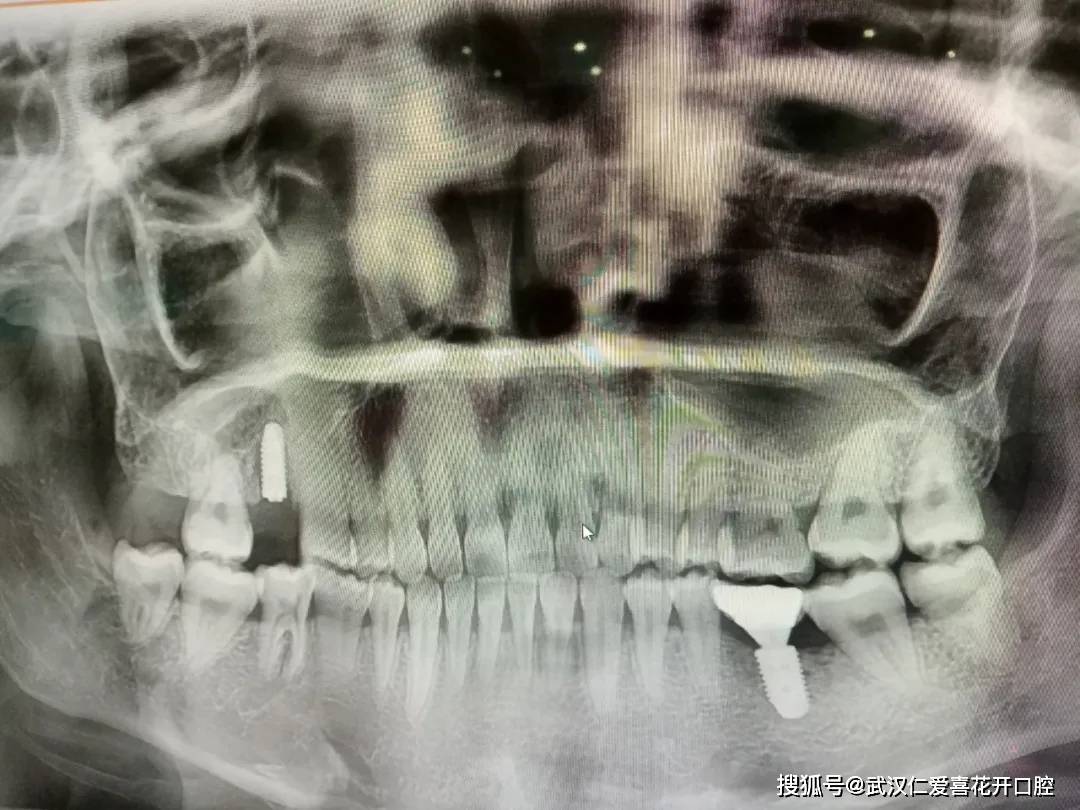 种牙全景片类似王先生这种牙齿缺失的问题,应当尽早引起重视!