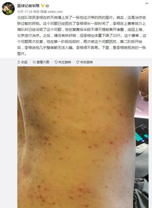 湿疹药膏排行榜_两种湿疹药膏有致癌风险(2)