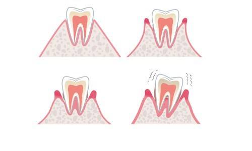 正畸治疗是否会造成牙齿松动?